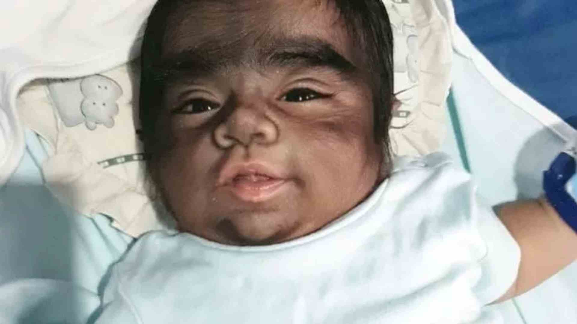 Babies Develop ‘Werewolf Syndrome’, Spain Reports 11 Cases | DETAILS